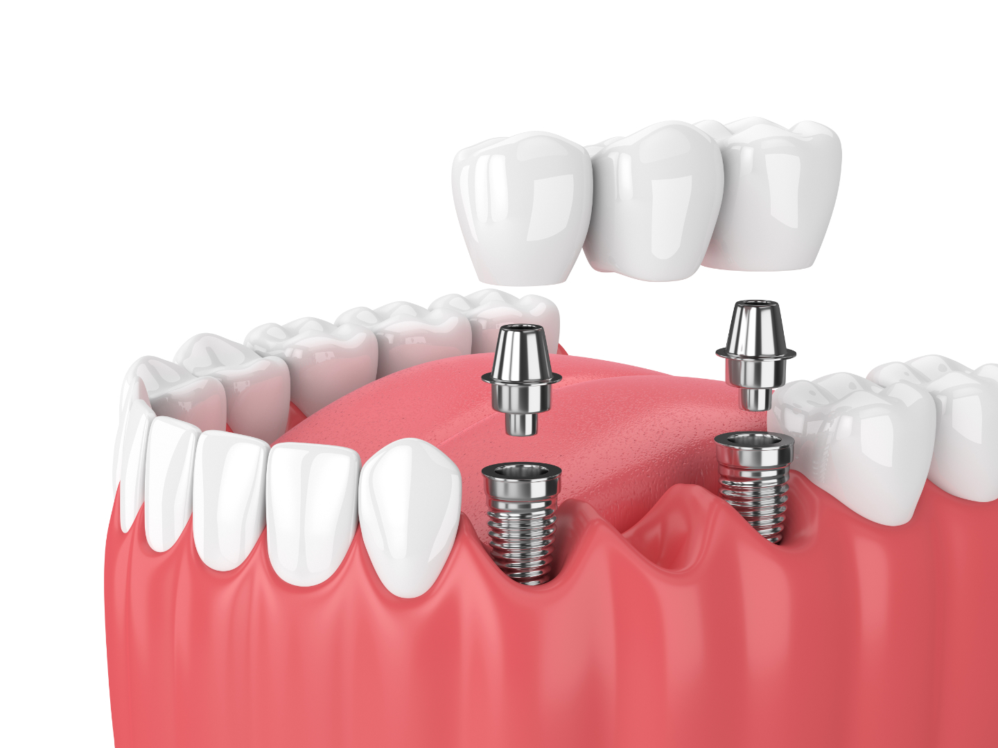 Harnessing Biocompatibility: The Next Leap in Dental Implant Success